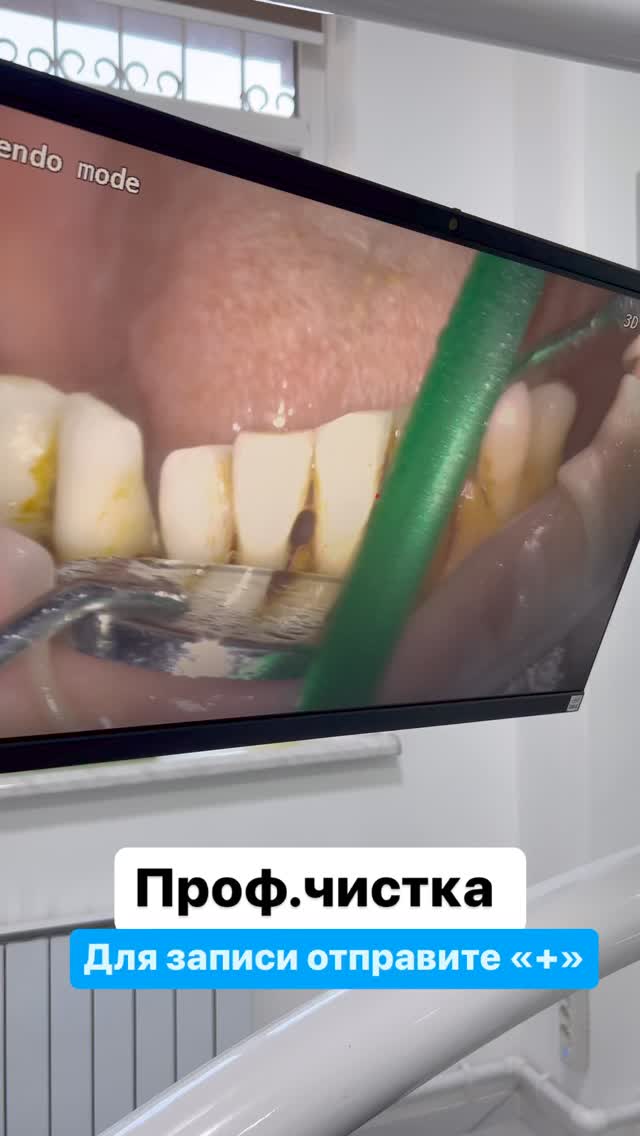 Результат профессиональной чистки