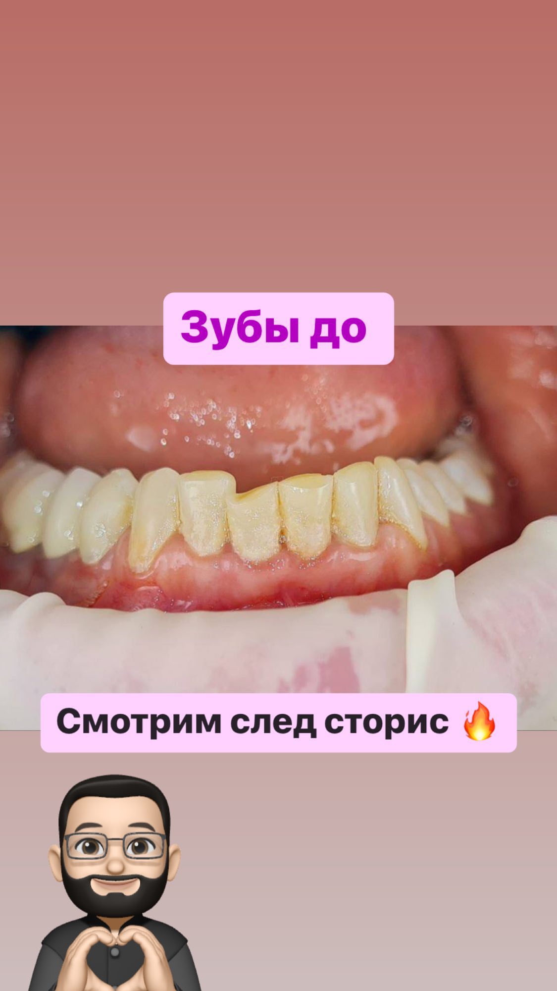 Виниры и коронки